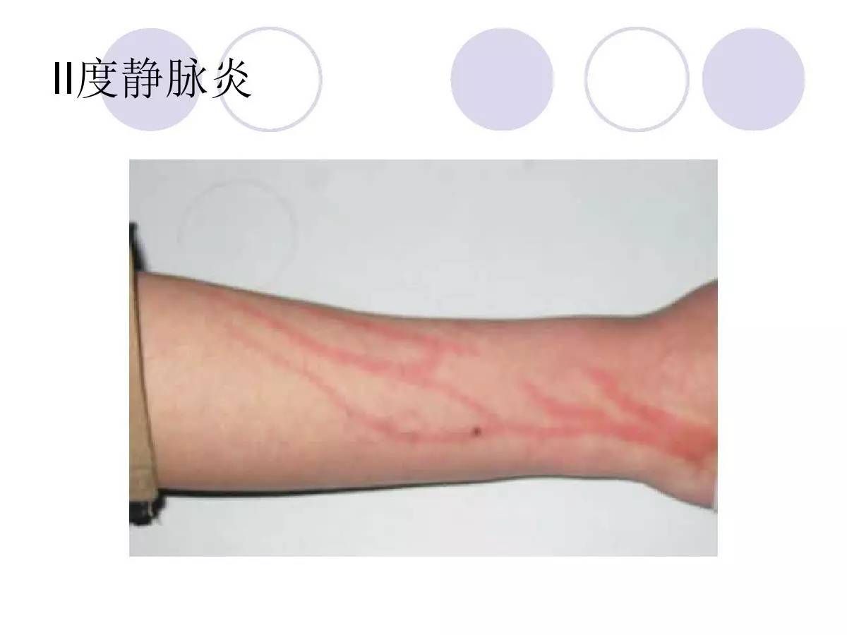 下列哪项不是常见的输液反应_以下哪几项是常见的输液反应_常见的输液反应有填空题